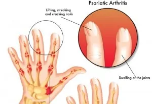 Псориатичен артрит – често задавани въпроси