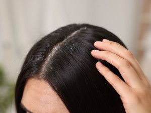 Псориазис на скалпа или пърхот