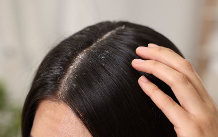 Псориазис на скалпа или пърхот