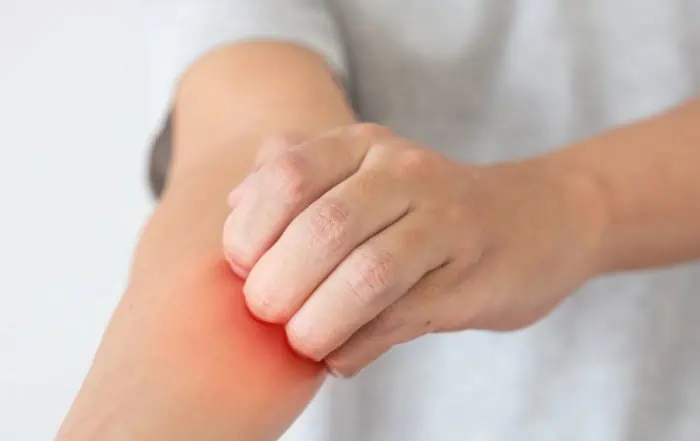 инвертен псориазис