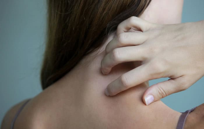 какво помага при псориазис