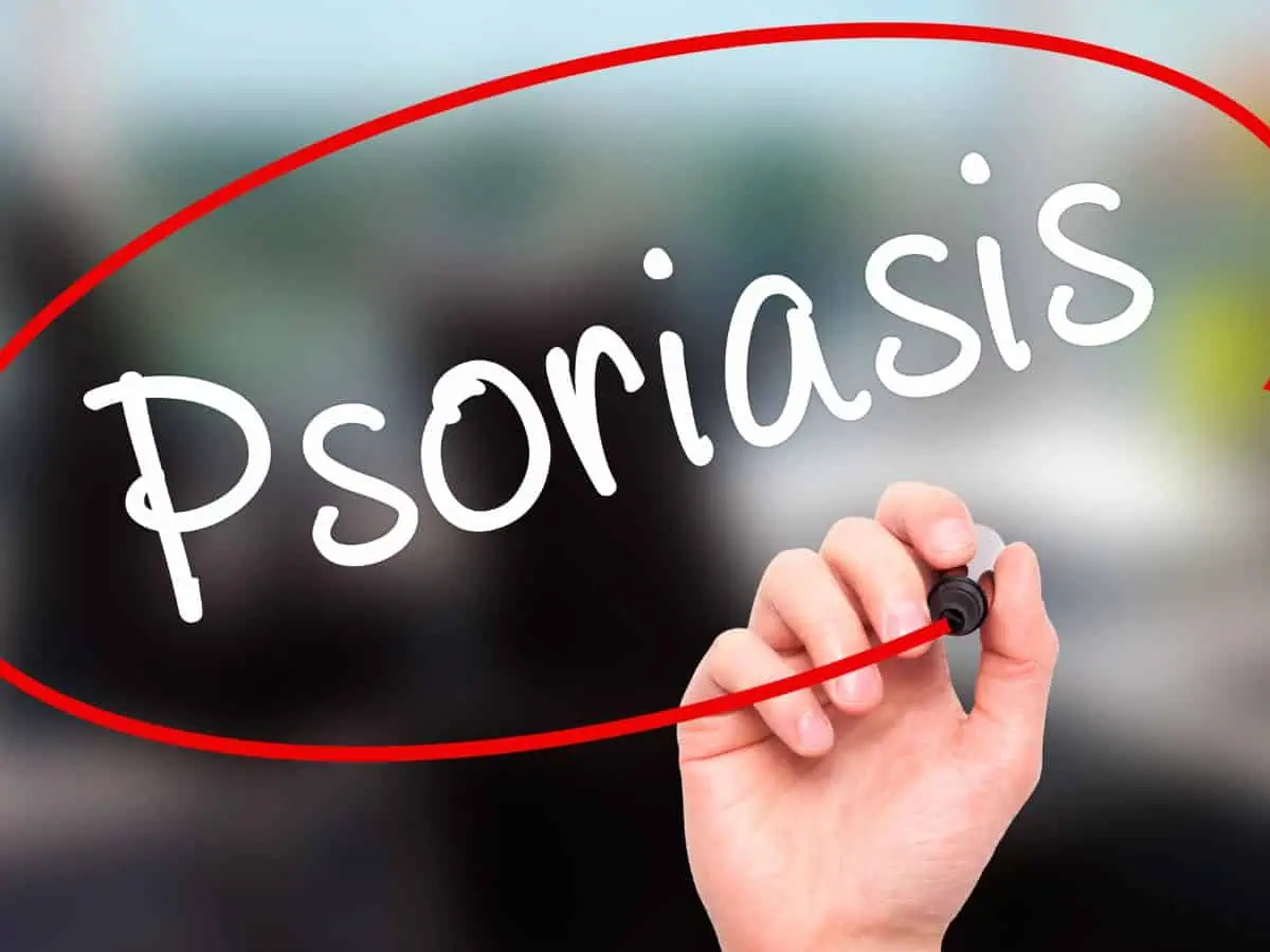 начални симптоми на псориазис